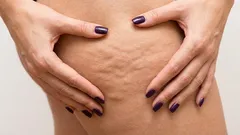 Many women are unaware of this method of getting rid of cellulite.